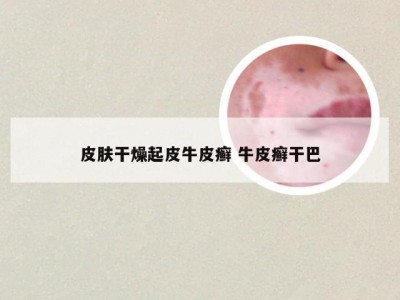 皮肤干燥起皮牛皮癣 牛皮癣干巴