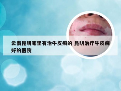 云南昆明哪里有治牛皮癣的 昆明治疗牛皮癣好的医院