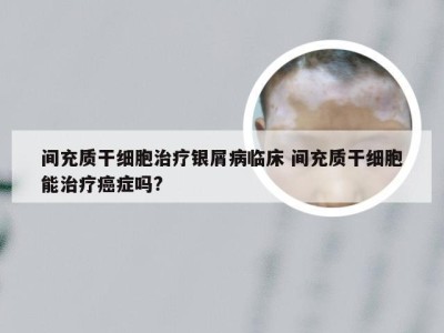 间充质干细胞治疗银屑病临床 间充质干细胞能治疗癌症吗?