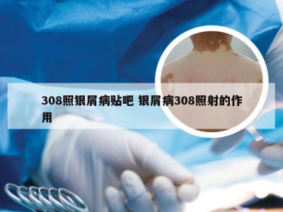 308照银屑病贴吧 银屑病308照射的作用