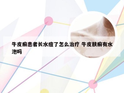 牛皮癣患者长水痘了怎么治疗 牛皮肤癣有水泡吗