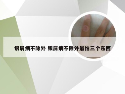 银屑病不除外 银屑病不除外最怕三个东西