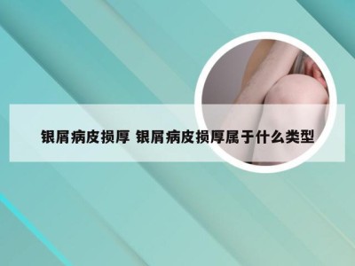银屑病皮损厚 银屑病皮损厚属于什么类型