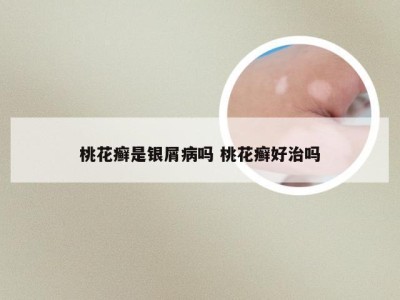 桃花癣是银屑病吗 桃花癣好治吗