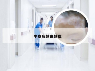 牛皮癣越来越痒