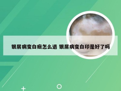 银屑病变白癍怎么退 银屑病变白印是好了吗