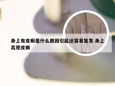 身上有皮癣是什么原因引起还容易复发 身上出现皮癣