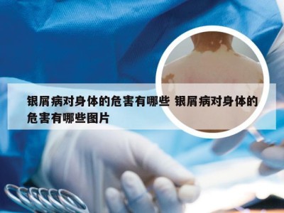 银屑病对身体的危害有哪些 银屑病对身体的危害有哪些图片