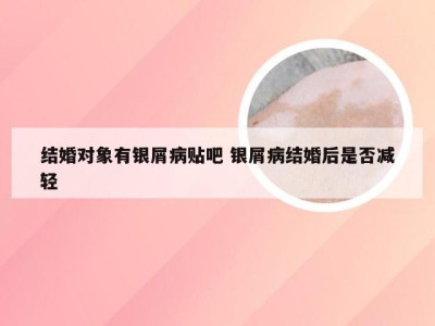 结婚对象有银屑病贴吧 银屑病结婚后是否减轻