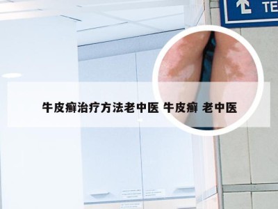 牛皮癣治疗方法老中医 牛皮癣 老中医