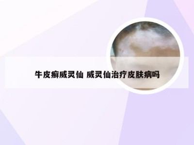 牛皮癣威灵仙 威灵仙治疗皮肤病吗