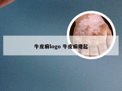 牛皮癣logo 牛皮癣隆起