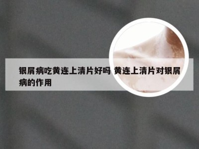 银屑病吃黄连上清片好吗 黄连上清片对银屑病的作用