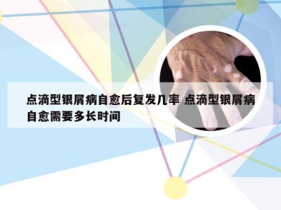 点滴型银屑病自愈后复发几率 点滴型银屑病自愈需要多长时间