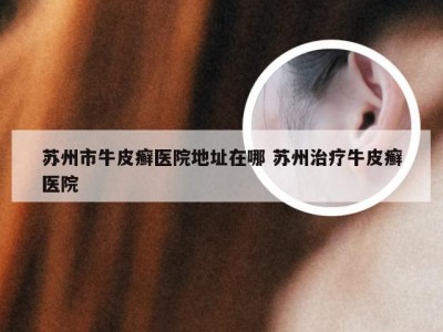 苏州市牛皮癣医院地址在哪 苏州治疗牛皮癣医院