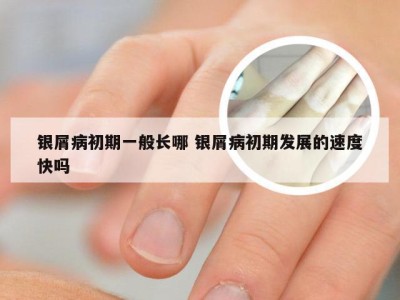 银屑病初期一般长哪 银屑病初期发展的速度快吗