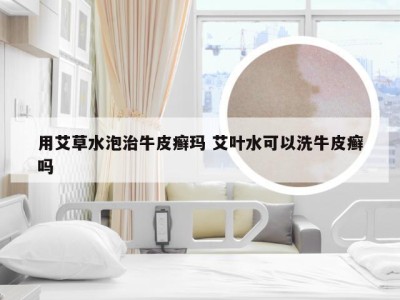 用艾草水泡治牛皮癣玛 艾叶水可以洗牛皮癣吗