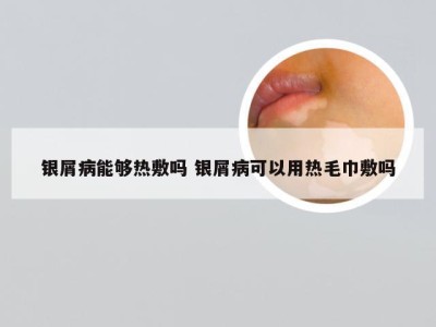 银屑病能够热敷吗 银屑病可以用热毛巾敷吗