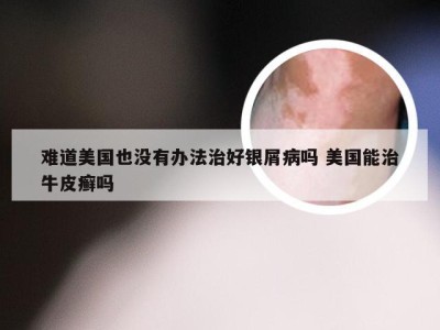 难道美国也没有办法治好银屑病吗 美国能治牛皮癣吗