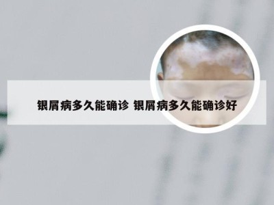 银屑病多久能确诊 银屑病多久能确诊好