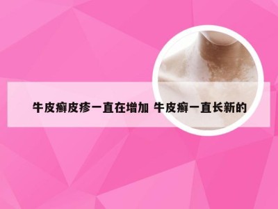 牛皮癣皮疹一直在增加 牛皮癣一直长新的
