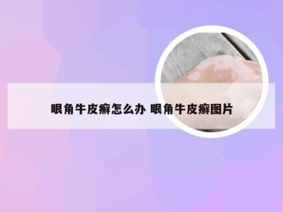 眼角牛皮癣怎么办 眼角牛皮癣图片