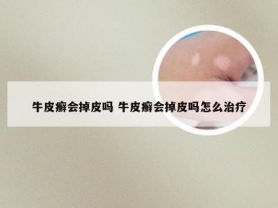 牛皮癣会掉皮吗 牛皮癣会掉皮吗怎么治疗