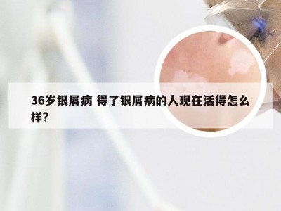 36岁银屑病 得了银屑病的人现在活得怎么样?