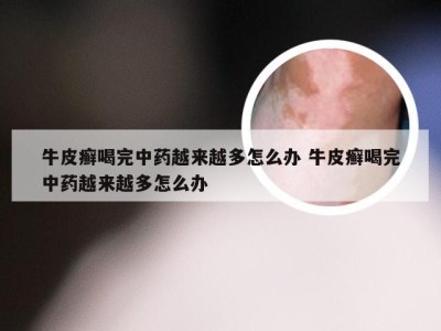 牛皮癣喝完中药越来越多怎么办 牛皮癣喝完中药越来越多怎么办