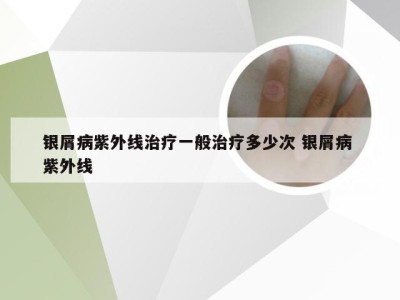 银屑病紫外线治疗一般治疗多少次 银屑病 紫外线