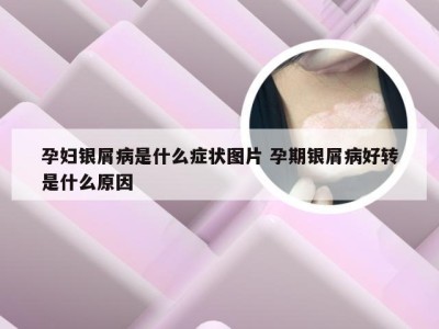 孕妇银屑病是什么症状图片 孕期银屑病好转是什么原因