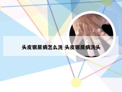 头皮银屑病怎么洗 头皮银屑病洗头