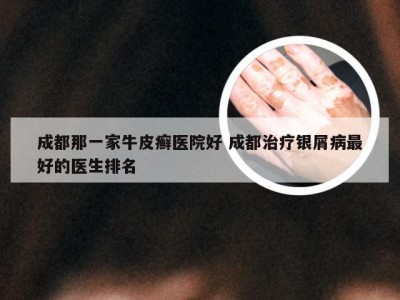 成都那一家牛皮癣医院好 成都治疗银屑病最好的医生排名