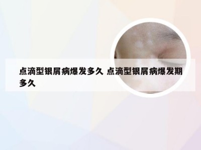 点滴型银屑病爆发多久 点滴型银屑病爆发期多久