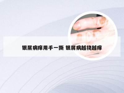 银屑病痒用手一撕 银屑病越挠越痒