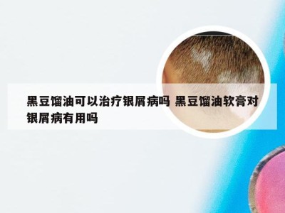 黑豆馏油可以治疗银屑病吗 黑豆馏油软膏对银屑病有用吗