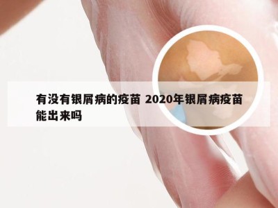 有没有银屑病的疫苗 2020年银屑病疫苗能出来吗