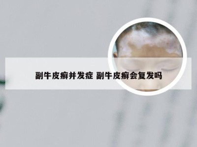 副牛皮癣并发症 副牛皮癣会复发吗