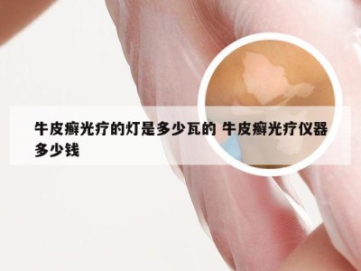 牛皮癣光疗的灯是多少瓦的 牛皮癣光疗仪器多少钱