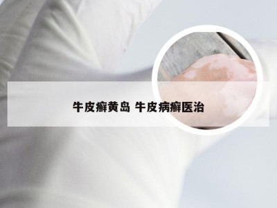 牛皮癣黄岛 牛皮病癣医治