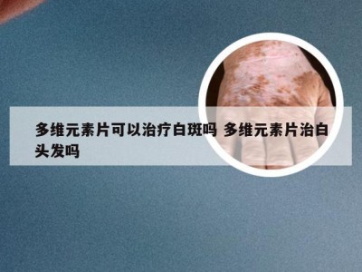 多维元素片可以治疗白斑吗 多维元素片治白头发吗