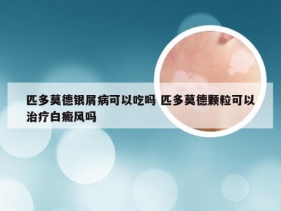 匹多莫德银屑病可以吃吗 匹多莫德颗粒可以治疗白癜风吗