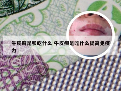 牛皮癣是和吃什么 牛皮癣是吃什么提高免疫力