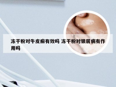 冻干粉对牛皮癣有效吗 冻干粉对银屑病有作用吗