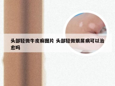头部轻微牛皮癣图片 头部轻微银屑病可以治愈吗