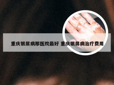 重庆银屑病那医院最好 重庆银屑病治疗费用