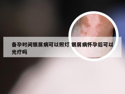 备孕时间银屑病可以照灯 银屑病怀孕后可以光疗吗