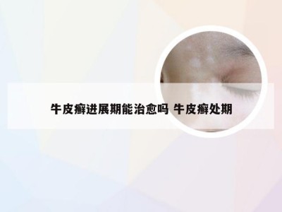 牛皮癣进展期能治愈吗 牛皮癣处期