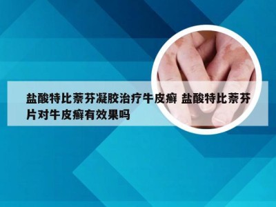盐酸特比萘芬凝胶治疗牛皮癣 盐酸特比萘芬片对牛皮癣有效果吗