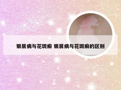 银屑病与花斑癣 银屑病与花斑癣的区别